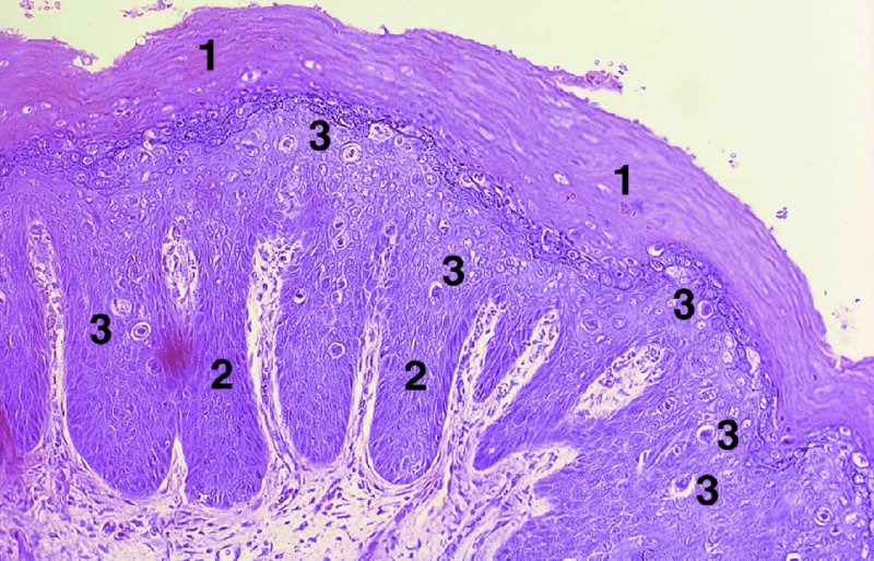 Vaginal Intraepithelial Neoplasia | Obgyn Key