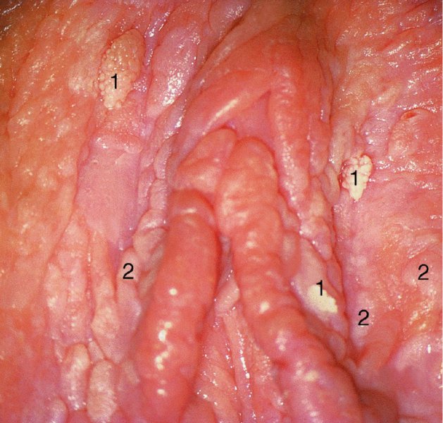 vulvar intraepithelial neoplasia (vin)