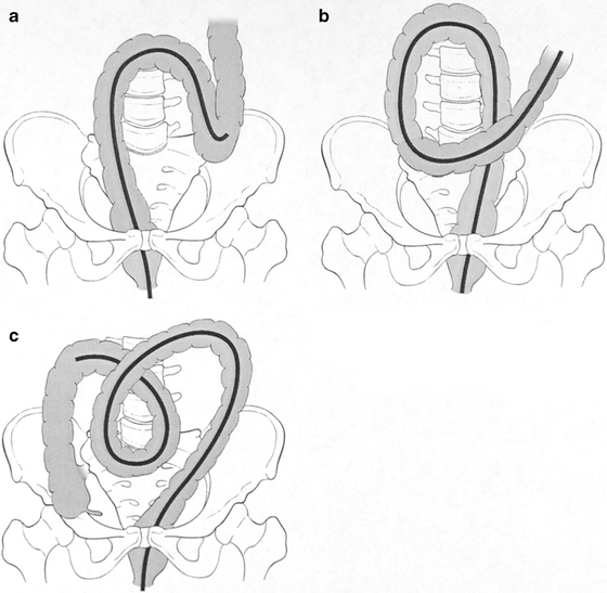 A126025_2_En_20_Fig3_HTML.gif