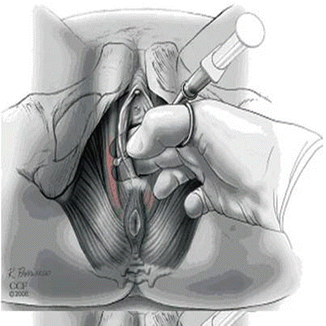 obturator internus trigger point