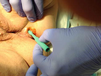 biopsy vulvar excision punch ablation keyes fig