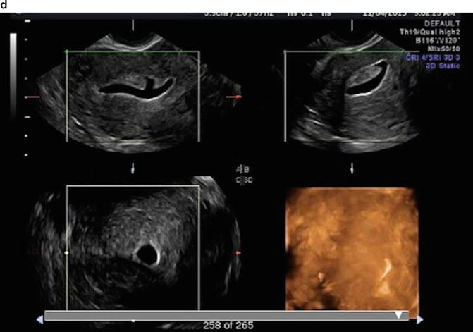 saline-infusion-sonography-sis-or-sonohysterography-shg-ultrasound