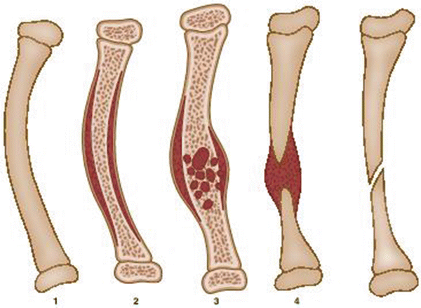 Pseudoartroza tibiei