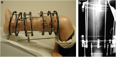 Cureus, Congenital Pseudoarthrosis of Tibia With Anterolateral Bowing  Treated With Ilizarov Ring Fixator: A Case Report