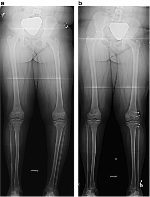 Controversies in Blount’s Disease | Obgyn Key