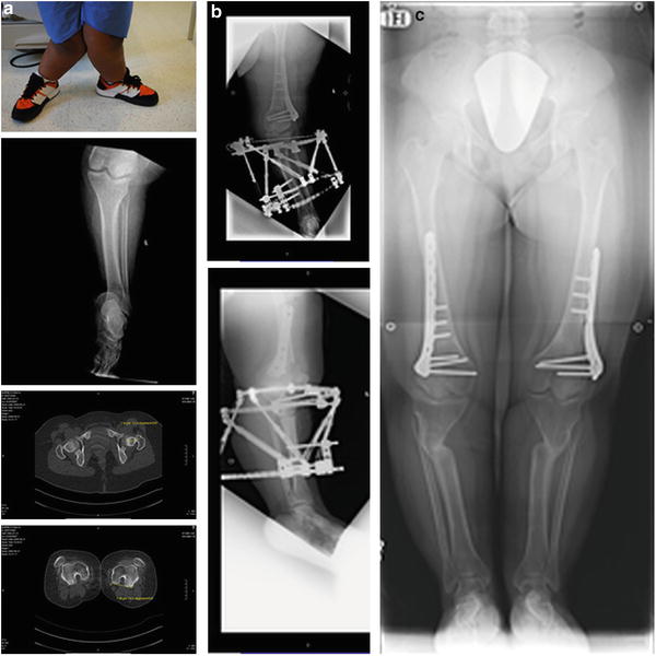 Tibia Lengthening and Deformity Correction With a Multiplanar External  Fixator