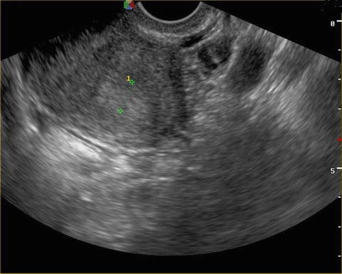 Abnormal Uterine Bleeding | Obgyn Key