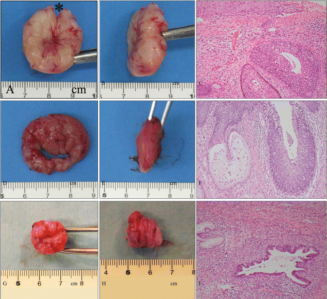 Vulvar cancer