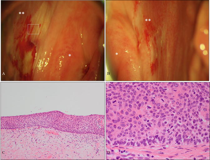 Clinical Management Of Selected Precancerous Lesions In The Lower
