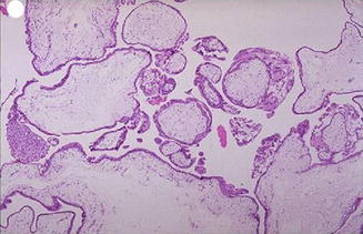 Gestational Trophoblastic Disease | Obgyn Key