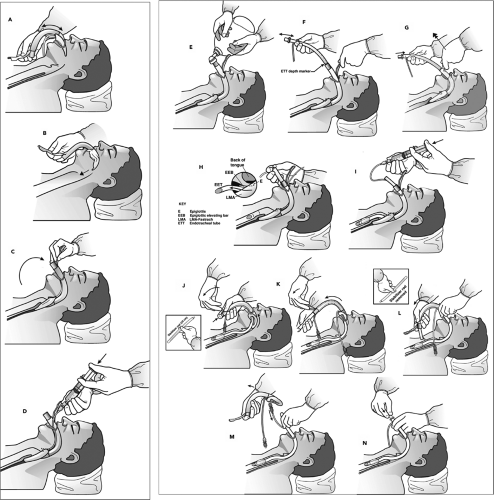 Management of the Difficult Airway | Obgyn Key