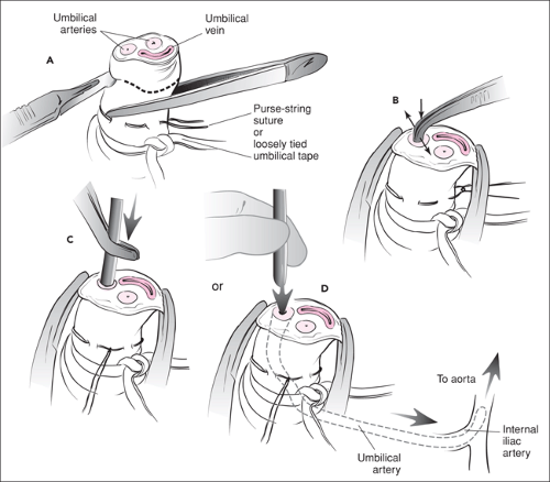Purse-String Suturing w/ Surgical Excision for Congenital AVM|VDM