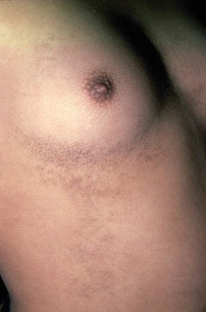 Confluent and reticulated papillomatosis itchy, Ce unguent poate fi imprastiat cu psoriazis