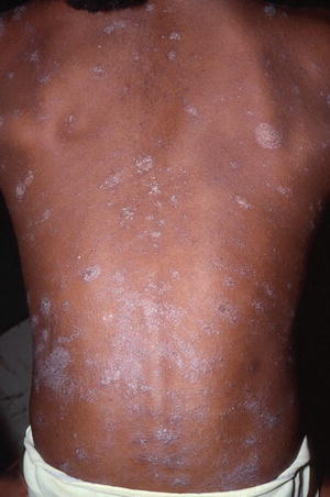 Tinea Capitis in Children of Colour | Obgyn Key