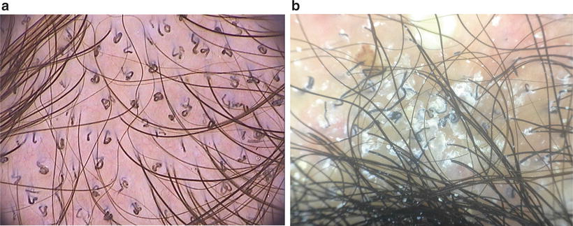 tinea capitis scalp ringworm