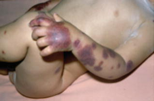 acute hemorrhagic edema of infancy