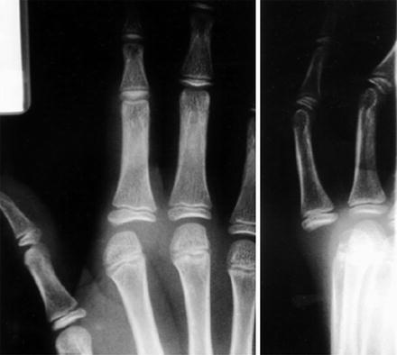 Hand Dislocations | Obgyn Key