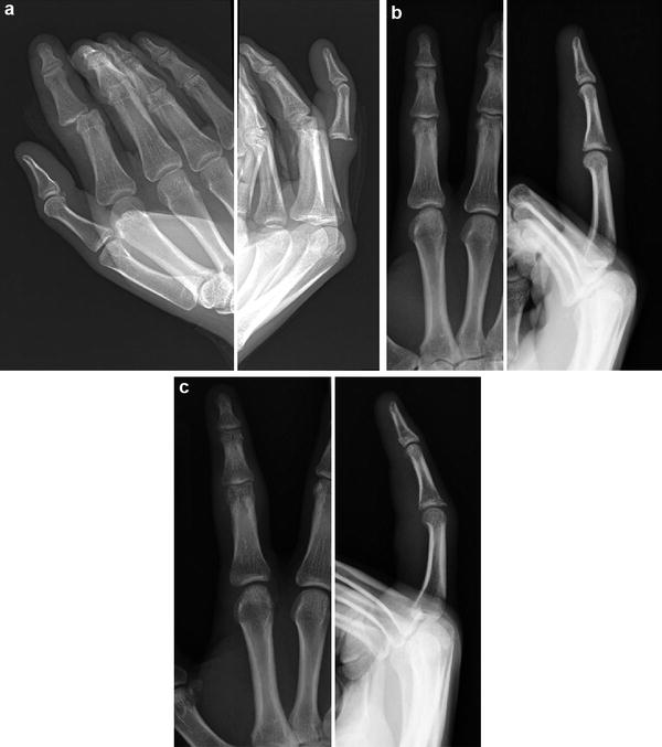 Hand Dislocations | Obgyn Key