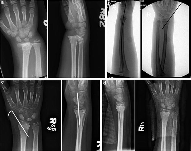 Distal Radius Fractures Obgyn Key