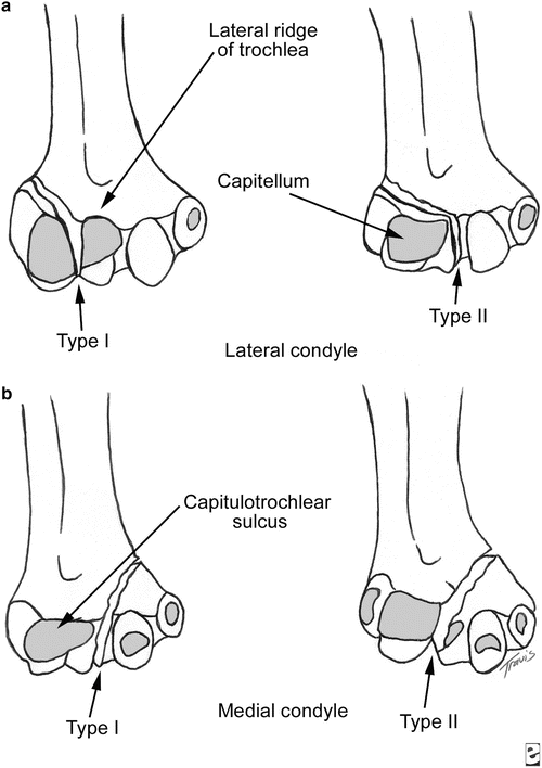 Distal Articular Humerus Fractures | Obgyn Key