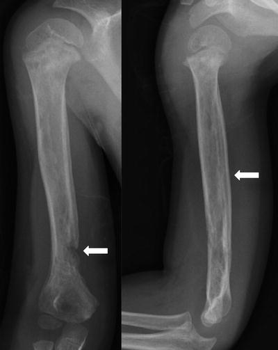 Osteomyelitis And Septic Arthritis | Obgyn Key