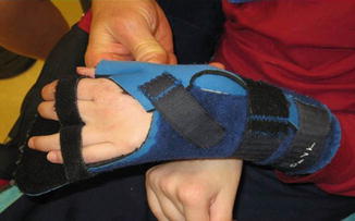 McKie Dorsal Stay Trigger Thumb Spica Splint (Pediatric Sizes)