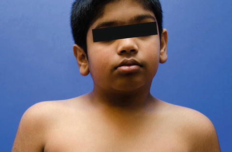A photograph of a child with Sprengel's deformity: (A) asymmetry of