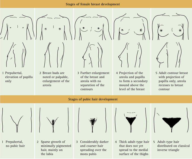 Stages of breast and pubic hair development. Stage 1 is