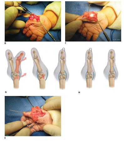 Preaxial Polydactyly | Obgyn Key extensor tendon diagram 