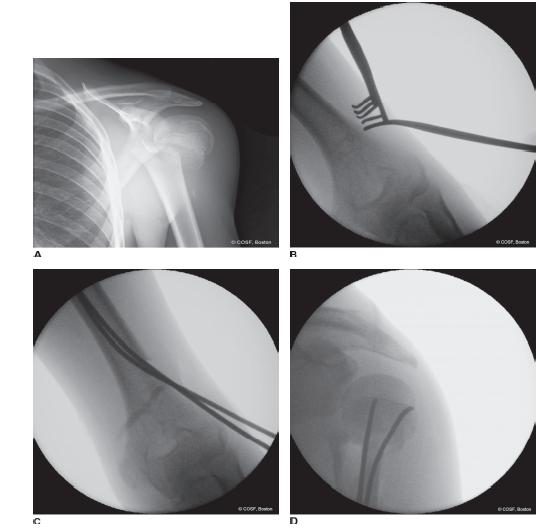 FOR DOCTORS PROXIMAL HUMERAL FRACTURES, EXTRA AARTICULAR 2-PART, SURGICAL  NECK, IMPACTION Fixation NAILING (STRAIGHT NAIL)