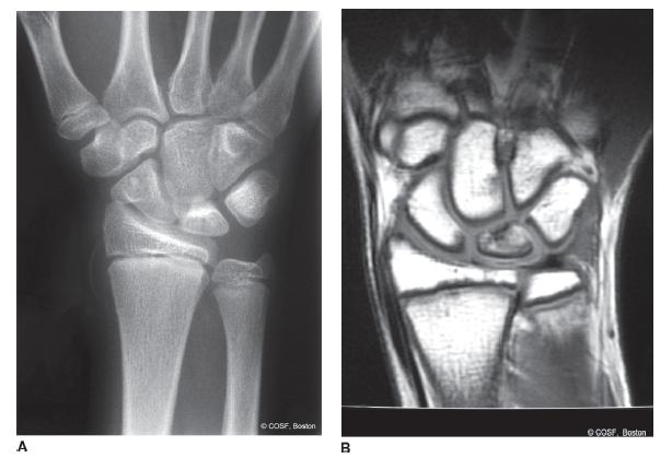 Distal Radius and Carpal Fractures | Obgyn Key