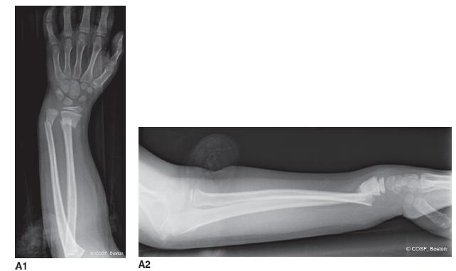 Distal Radius and Carpal Fractures | Obgyn Key