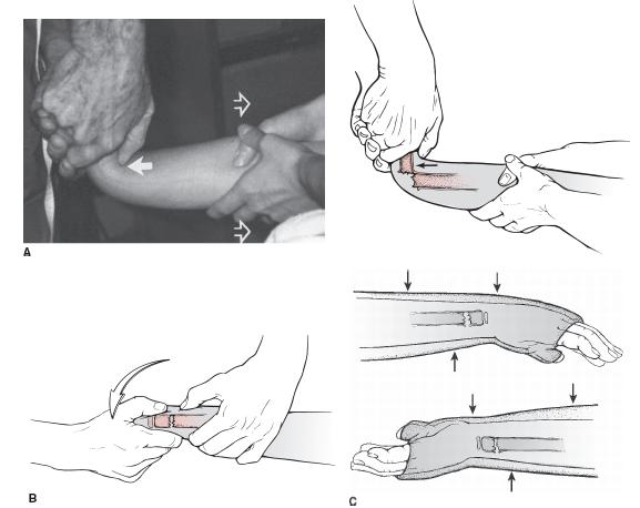 Distal Radius and Carpal Fractures Obgyn Key