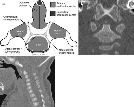 odontoid processes