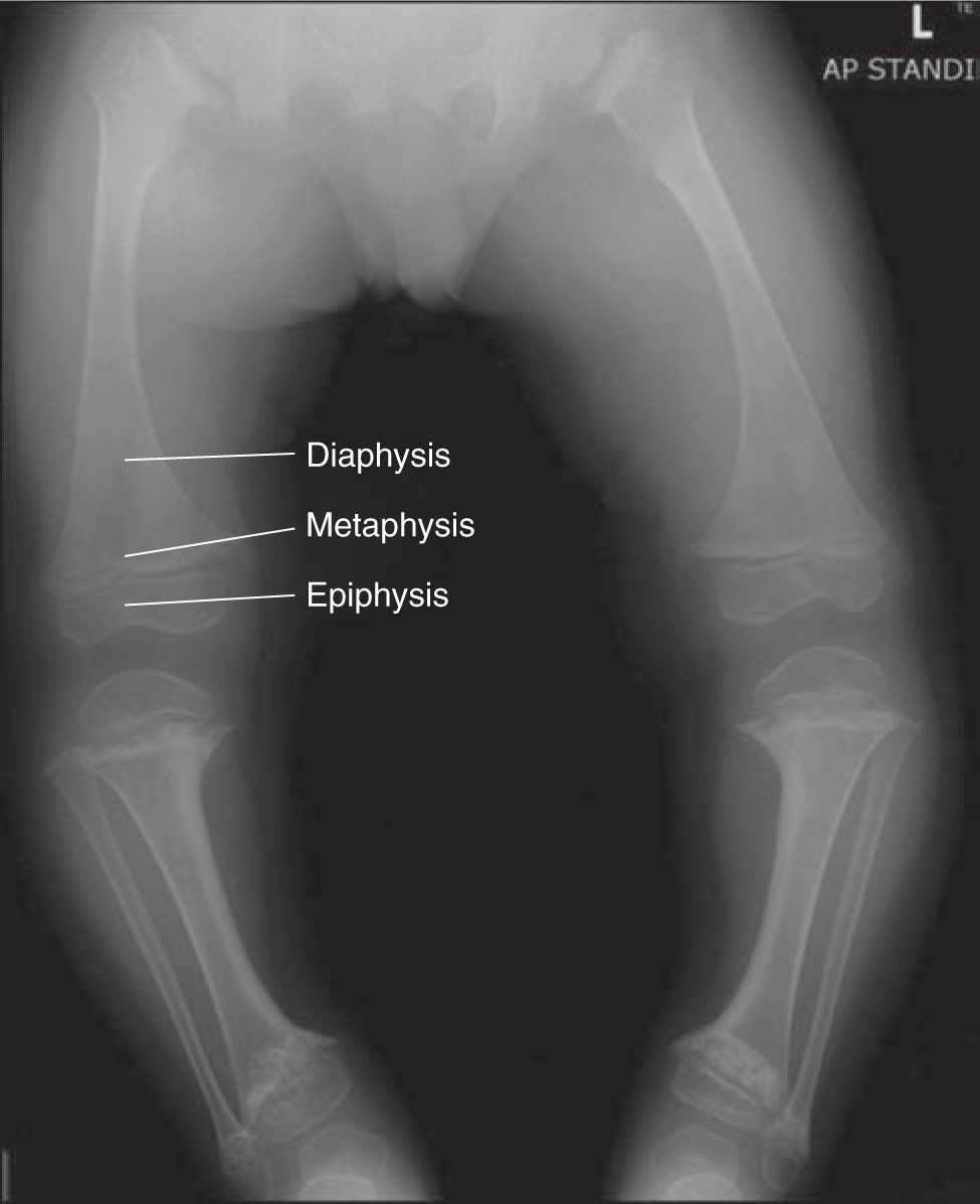 Skeletal Dysplasias | Obgyn Key