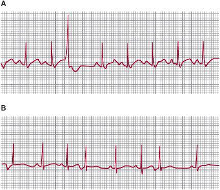 ectopic beat compensatory pause ventricular followed arrhythmias pauses premature atrial beats following figure