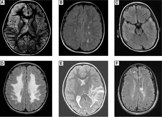 . Immune- and Inflammatory-Mediated Central Nervous System Syndromes ...