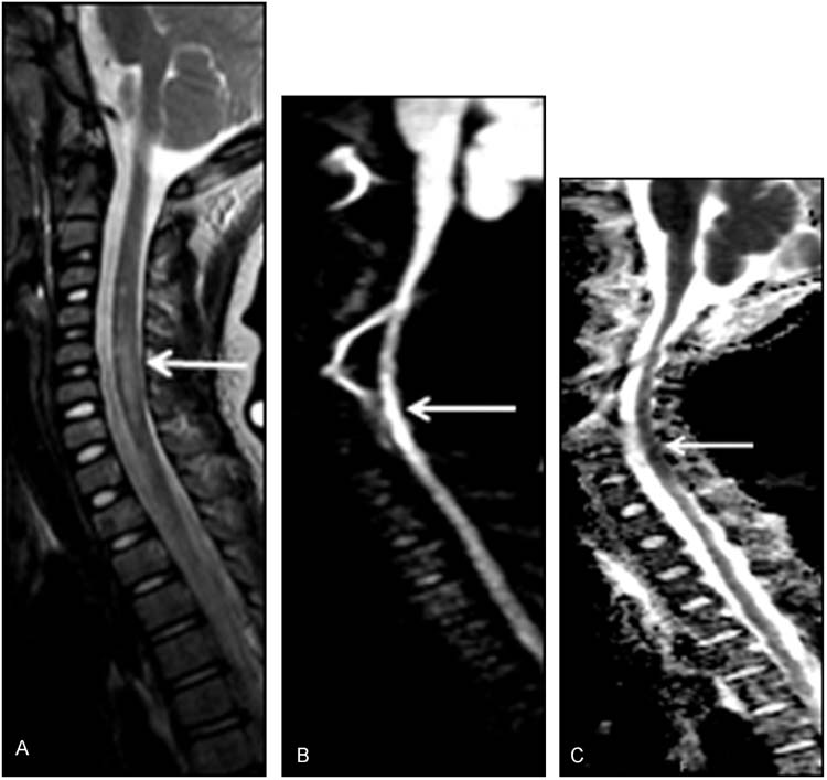 Spinal Cord Disease And Injury | Obgyn Key