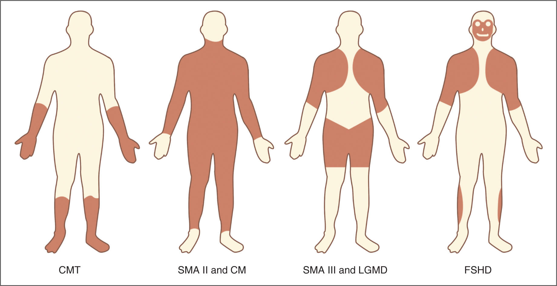 Types Of Neuromuscular Disease