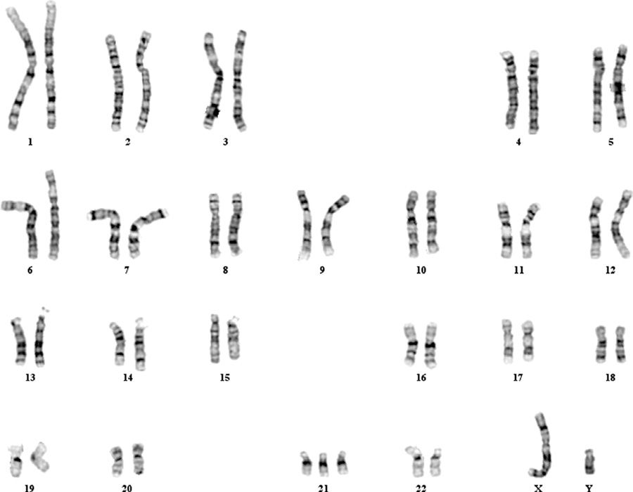 A case of mosaic ring chromosome 13 syndrome