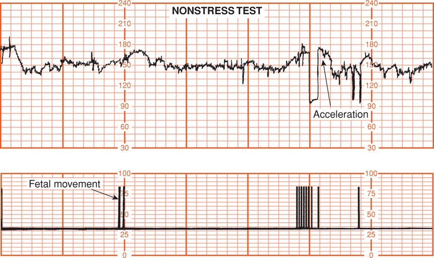 Reactive Fetal Heart Rate Tracing