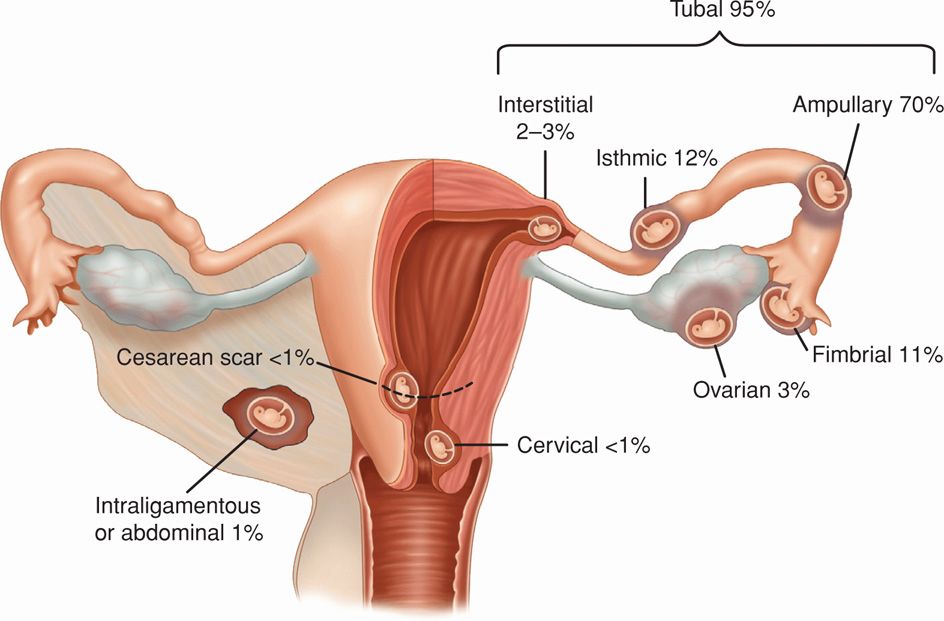 methotrexate injection for ectopic pregnancy