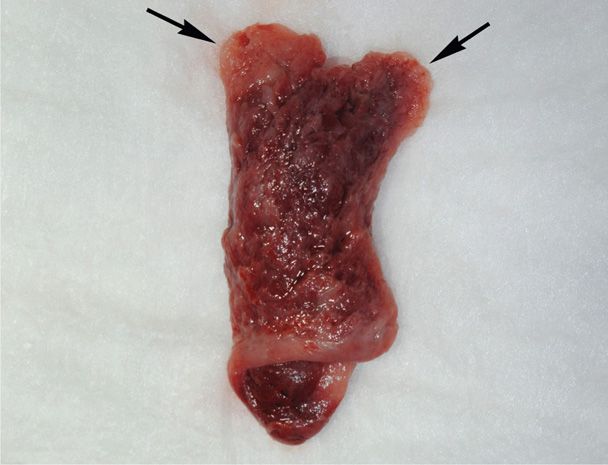 Ectopic Pregnancy