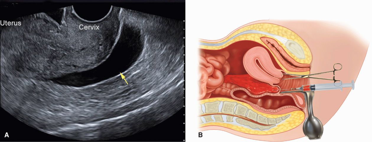 Ectopic Pregnancy Obgyn Key