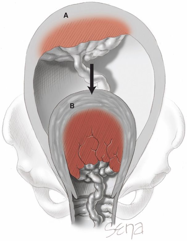 Valvular heart disease: Types and presentation | Kenhub