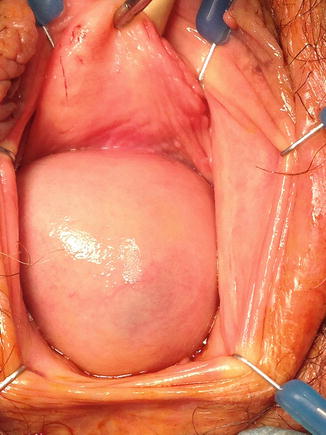 Cureus  A Rare Case of Posterior Vaginal Wall Gartner's Duct Cyst