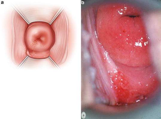 Laparoscopic Resection of an Epidermal Inclusion Cyst at the Vaginal Cuff -  ScienceDirect