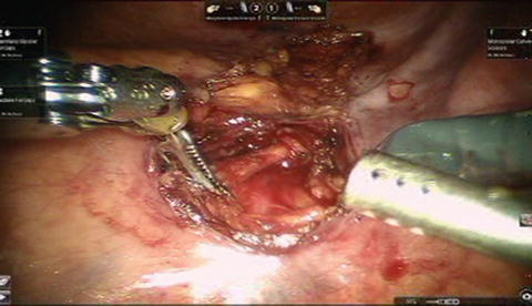 Excision of Vaginal Cysts