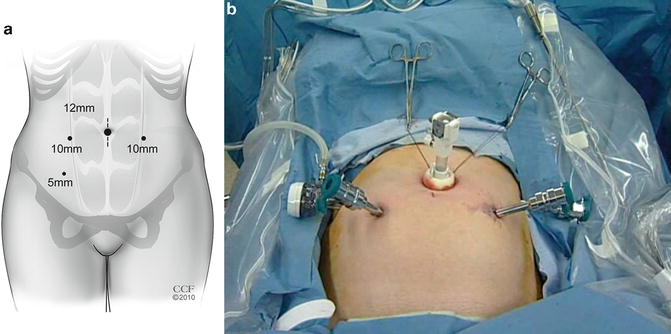 Robotic Assisted Sacrocolpopexy of Uterine and Vaginal Prolapse