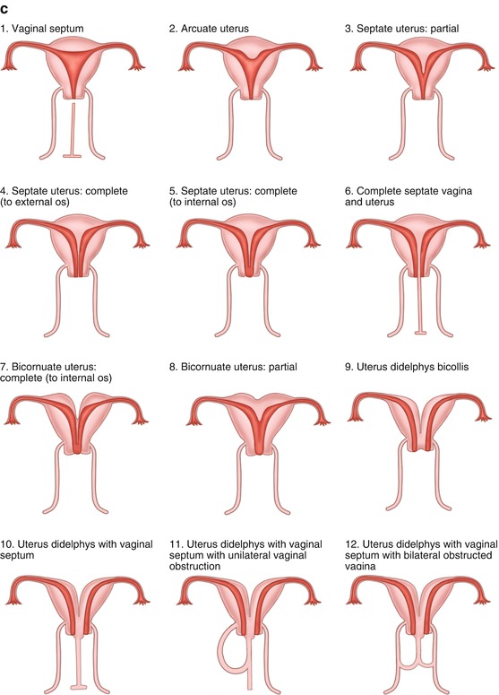 Transverse Vaginal Septum Causing Hematocolpos